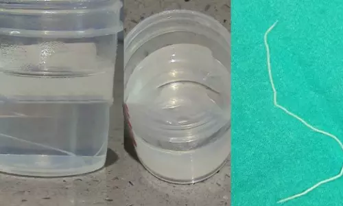 അസഹ്യമായ വേദന; മാഹി സ്വദേശിയുടെ കണ്ണില്‍ നിന്നു പുറത്തെടുത്തത് 20 മില്ലിമീറ്റര്‍ നീളമുള്ള വിര