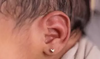 കാത് കുത്താന്‍ അനസ്‌തേഷ്യ നല്‍കി; ആറ് മാസം പ്രായമുള്ള കുഞ്ഞ് മരിച്ചു