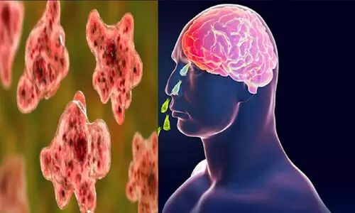 കോഴിക്കോട്ട് സ്വദേശിനിക്ക് അമീബിക് മസ്തിഷ്ക ജ്വരം സ്ഥിരീകരിച്ചു കോഴിക്കോട്ട് സ്വദേശിനിക്ക് അമീബിക് മസ്തിഷ്ക ജ്വരം സ്ഥിരീകരിച്ചു