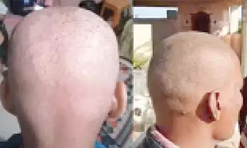 മഹാരാഷ്ട്രയിലെ മുടികൊഴിച്ചിലിന് കാരണം റേഷന്‍ ഗോതമ്പിലെ സെലിനിയമെന്ന് വിദഗ്ദ സമിതി