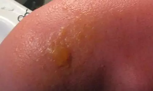 മുക്കത്ത് കര്‍ഷകന് സൂര്യാഘാതമേറ്റു