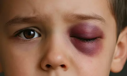 ടീച്ചര്‍ എറിഞ്ഞ വടി കണ്ണില്‍ കൊണ്ടു: കര്‍ണാടകത്തില്‍ സ്‌കൂള്‍ വിദ്യാര്‍ഥിയുടെ കാഴ്ച നഷ്ടപ്പെട്ടു