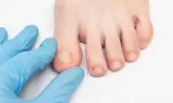 മുടി കൊഴിച്ചിലിനു പിറകെ, നഖം പൊഴിഞ്ഞു പോകല്‍; വീണ്ടും ആശങ്കയില്‍ മഹാരാഷ്ട്രയിലെ ബുല്‍ദാന