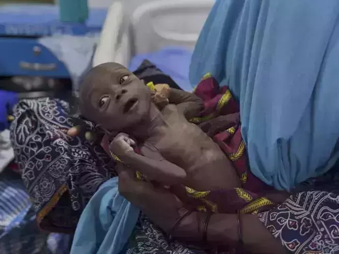 യുഎസ് സഹായം വെട്ടിക്കുറച്ചു; ആഫ്രിക്കയില്‍ നിരവധി കുട്ടികള്‍ മരിക്കുന്നു(ചിത്രങ്ങള്‍)