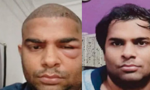 ഹെയര് ട്രാന്സ്പ്ലാന്റ് പിഴച്ചു; രണ്ടു മരണം ഹെയര് ട്രാന്സ്പ്ലാന്റ് പിഴച്ചു; രണ്ടു മരണം