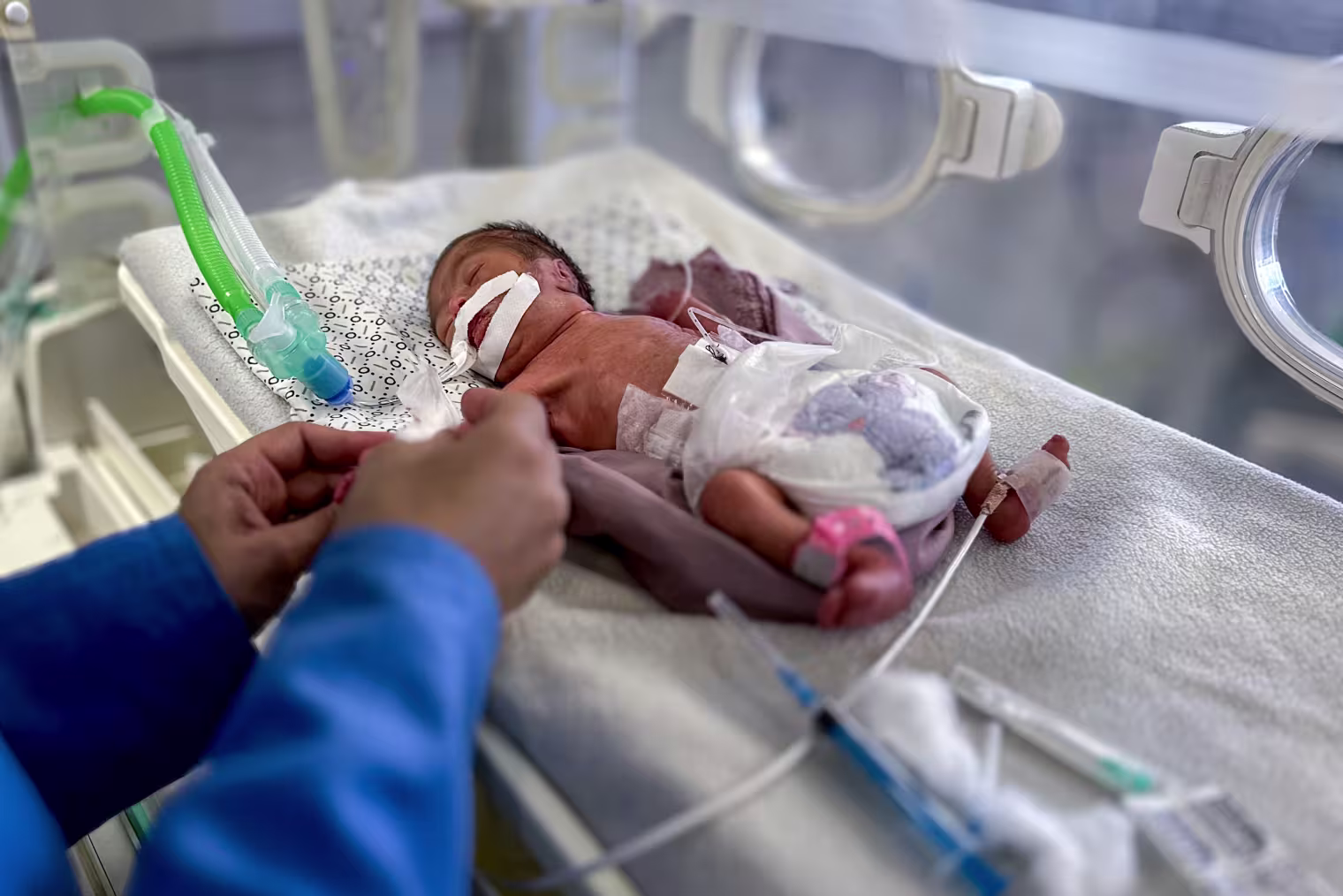 2023 ഒക്ടോബർ ഏഴുമുതൽ പട്ടിണിമൂലം ഗസയിൽ മരിച്ചത് 60 ലധികം കുഞ്ഞുങ്ങൾ