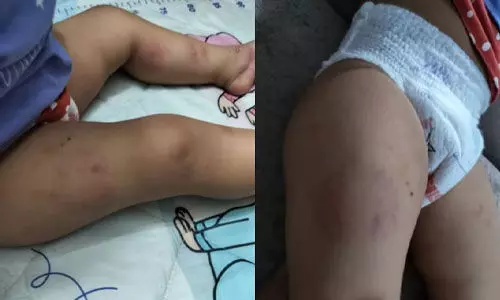 നിലത്തെറിഞ്ഞു, മുഖത്തടിച്ചു, തുടയില്‍ കടിച്ചു; പിഞ്ചുകുഞ്ഞിനോട് ഡേകെയര്‍ ജീവനക്കാരിയുടെ ക്രൂരത