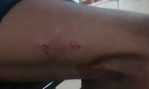 പൂജാരിയടക്കം അഞ്ചു പേരെ തെരുവുനായ കടിച്ചു