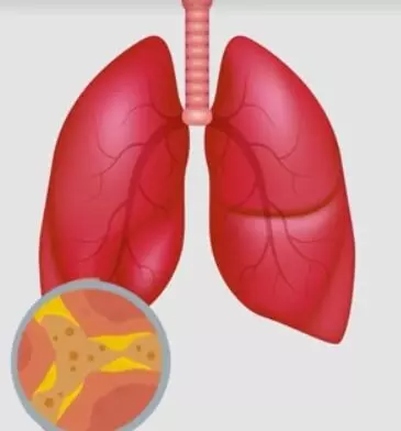 ആസ്മ വില്ലനാകുന്നോ? ; ആഗോളതലത്തില്‍, ആസ്മ കേസുകളില്‍ 13 ശതമാനവും ഇന്ത്യയില്‍