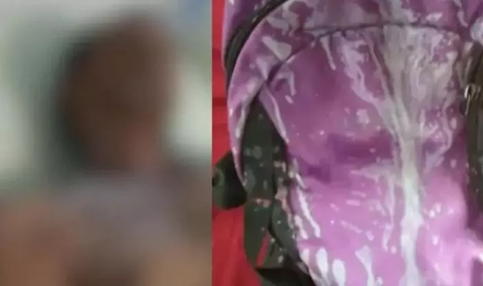 ആസിഡ് ദേഹത്തുവീണ് ബൈക്ക് യാത്രികന് ഗുരുതര പരിക്ക്