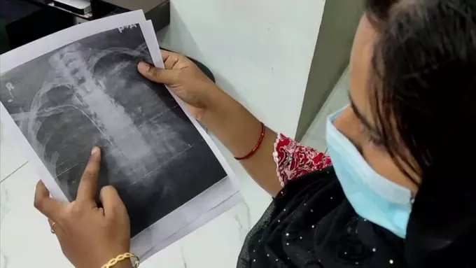 ഗൈഡ് വയര് കുടുങ്ങിയ സംഭവം; പ്രത്യേക മെഡിക്കല് ബോര്ഡ് രൂപീകരിക്കാന് ആവശ്യപ്പെട്ട് പോലിസ് ഡിഎംഓക്ക് കത്ത് നല്കി ഗൈഡ് വയര് കുടുങ്ങിയ സംഭവം; പ്രത്യേക മെഡിക്കല് ബോര്ഡ് രൂപീകരിക്കാന് ആവശ്യപ്പെട്ട് പോലിസ് ഡിഎംഓക്ക് കത്ത് നല്കി