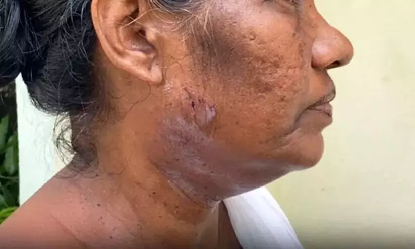 എസ്‌ഐആര്‍ സര്‍വേക്കെത്തിയ ബിഎല്‍ഒയ്ക്ക് നേരെ നായയെ അഴിച്ചുവിട്ട് വീട്ടുടമ