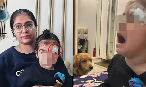 കുഞ്ഞിന്റെ മുറിവില്‍ തുന്നലിനു പകരം ഫെവിക്വിക്ക് പുരട്ടി ഡോക്ടര്‍