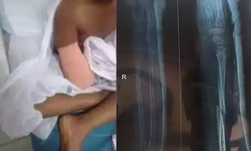 ഒന്പതു വയസ്സുകാരിയുടെ കൈ മുറിച്ച് മാറ്റിയ സംഭവം: കുടുംബം പരാതിയുമായി വികസന വകുപ്പിലേക്ക് ഒന്പതു വയസ്സുകാരിയുടെ കൈ മുറിച്ച് മാറ്റിയ സംഭവം: കുടുംബം പരാതിയുമായി വികസന വകുപ്പിലേക്ക്