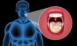 ഓറല് കാന്സര് ബാധിതരുടെ എണ്ണത്തില് ആശങ്കാജനകമായ വര്ധന, റിപോര്ട്ട് ഓറല് കാന്സര് ബാധിതരുടെ എണ്ണത്തില് ആശങ്കാജനകമായ വര്ധന, റിപോര്ട്ട്