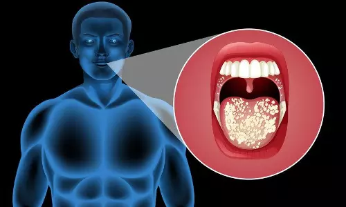 ഓറല്‍ കാന്‍സര്‍ ബാധിതരുടെ എണ്ണത്തില്‍ ആശങ്കാജനകമായ വര്‍ധന, റിപോര്‍ട്ട്