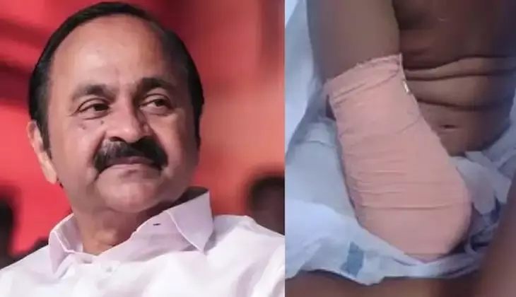 ചികില്‍സാ പിഴവിനെ തുടര്‍ന്ന് ഒന്‍പതുകാരിക്ക് കൈ നഷ്ടപ്പെട്ട സംഭവം; കൃത്രിമ കൈയ്ക്ക് ആവശ്യമായ മുഴുവന്‍ തുകയും അടച്ചെന്ന് വി ഡി സതീശന്‍