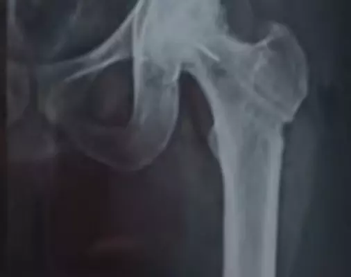 ശസ്ത്രക്രിയക്കിടെ ഡ്രില് ബിറ്റ് ഒടിഞ്ഞ് അസ്ഥിയിലേക്ക് കയറി; ആശുപത്രിക്കെതിരേ പരാതി ശസ്ത്രക്രിയക്കിടെ ഡ്രില് ബിറ്റ് ഒടിഞ്ഞ് അസ്ഥിയിലേക്ക് കയറി; ആശുപത്രിക്കെതിരേ പരാതി