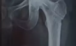 ശസ്ത്രക്രിയക്കിടെ ഡ്രില്‍ ബിറ്റ് ഒടിഞ്ഞ് അസ്ഥിയിലേക്ക് കയറി; ആശുപത്രിക്കെതിരേ പരാതി