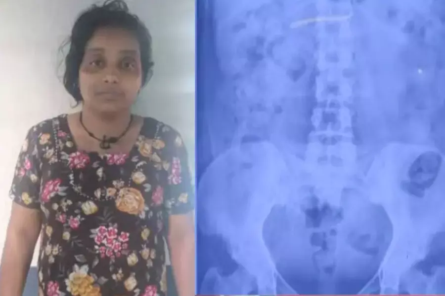 സ്വര്‍ണമാല മോഷ്ടിച്ച് വിഴുങ്ങിയ യുവതിയെ കോഴിക്കോട് മെഡിക്കല്‍ കോളേജ് ആശുപത്രിയിലേക്ക് മാറ്റി