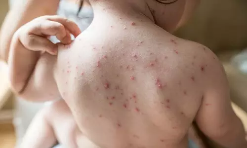 സംസ്ഥാനത്ത് ചിക്കന്‍പോക്‌സ് വ്യാപനം രൂക്ഷം; ഒന്നര മാസത്തില്‍ 5,791 പേര്‍ക്ക് രോഗബാധ