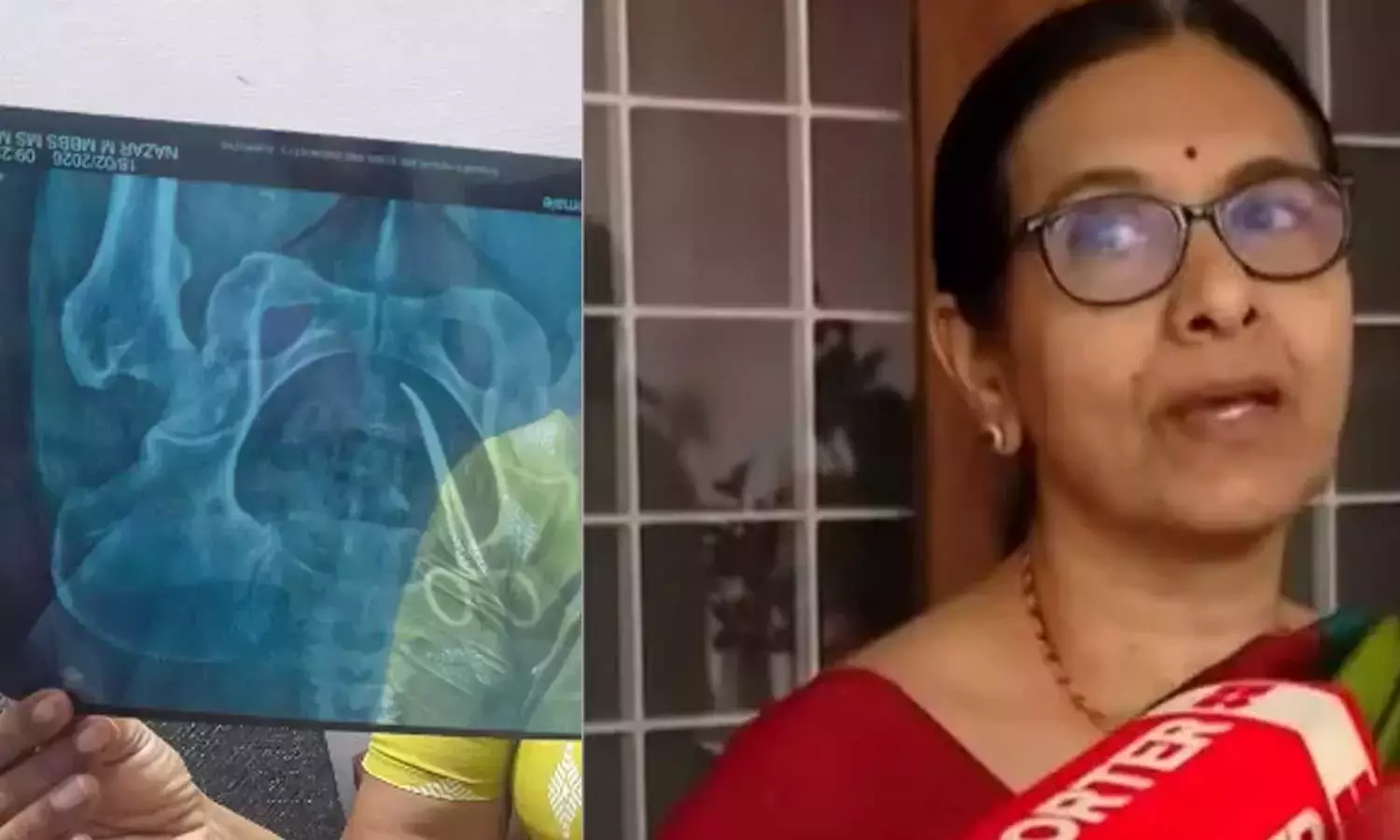 വണ്ടാനം മെഡിക്കല്‍ കോളേജില്‍ വയറ്റില്‍ കത്രിക കുടുങ്ങിയ സംഭവം; ഡോ. ലളിതാംബികയ്‌ക്കെതിരേ കേസെടുത്തു